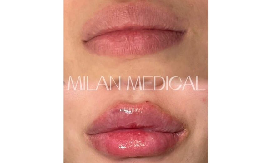 Image 8: One Syringe of Revanesse Versa for Lips or Face at Milan Medical