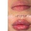 Image 8: One Syringe of Revanesse Versa for Lips or Face at Milan Medical