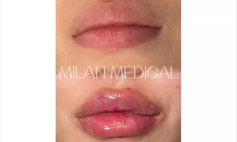 One Syringe of Revanesse Versa for Lips or Face at Milan Medical