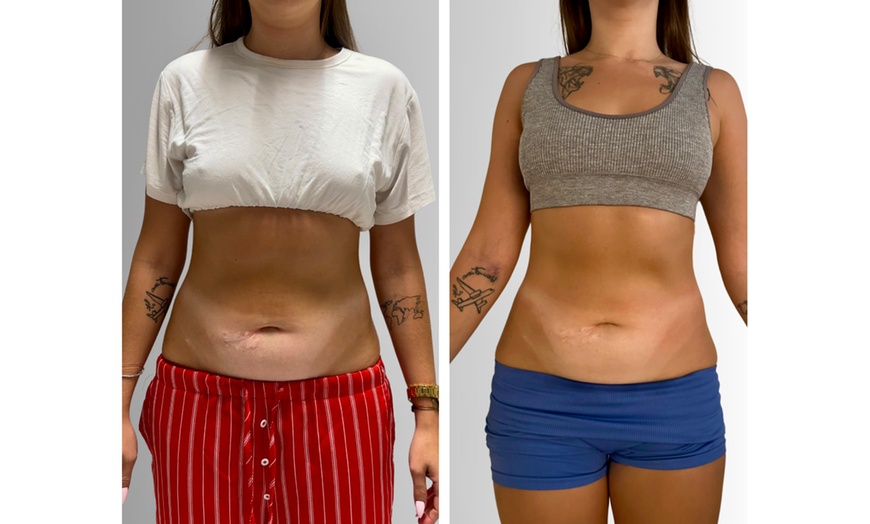 Image 3: Get 1x, 2x, 3x EMS Body Sculpting / Muscle Sculpting w/ nuFORM 16E