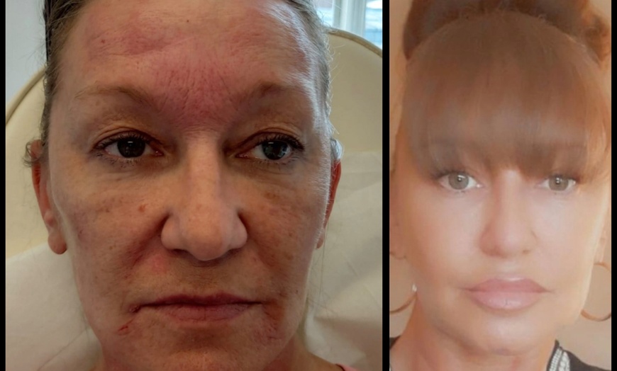 Image 4: Enhance Natural Beauty with Expert Dermal Filler Injections(0.5ml–2ml)