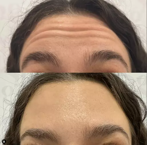 Look & Feel Younger with 20- 60 Units of Botox w/ Expert Aesthetician