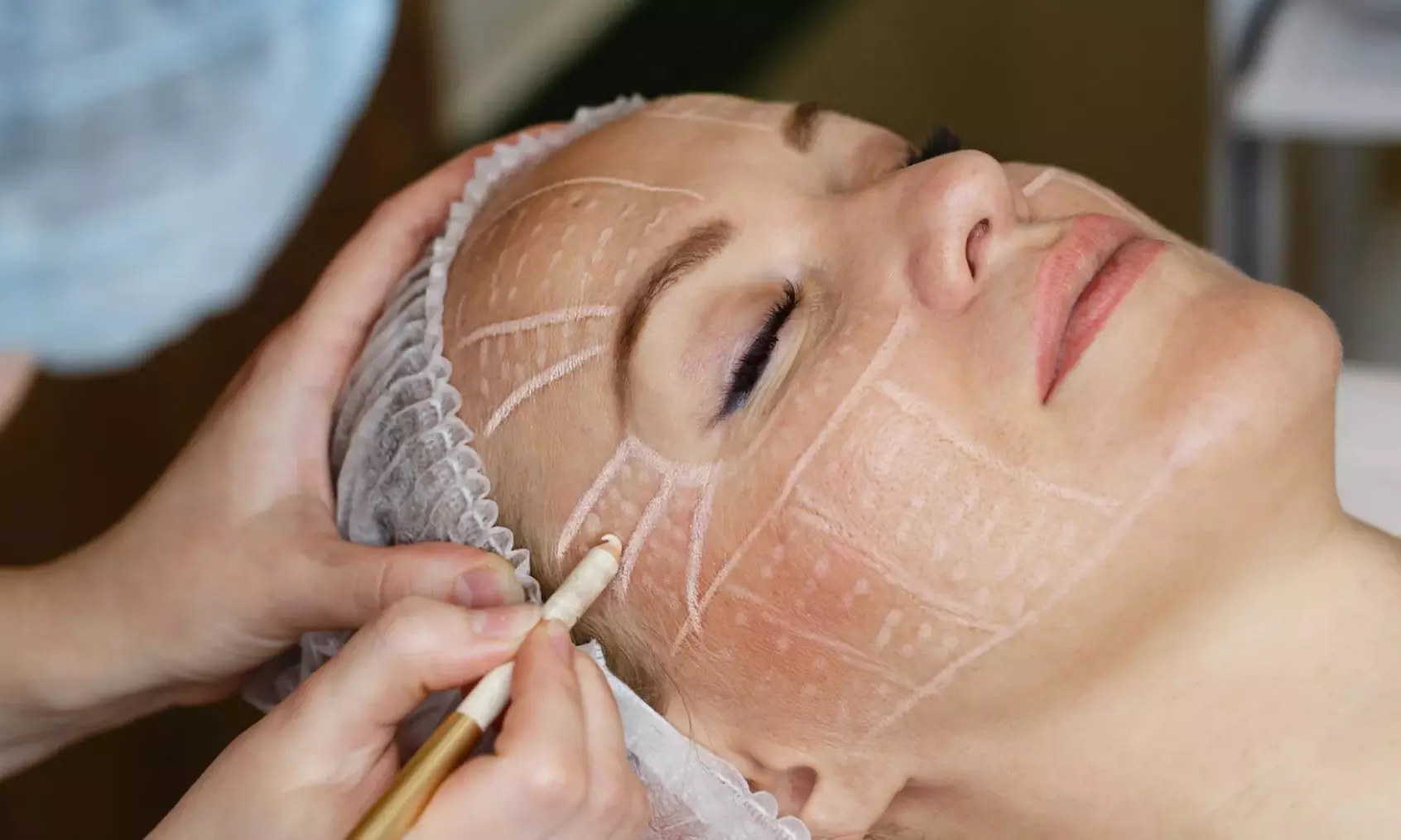 8-Punkte-Gesichtsbehandlung mit 2,5 ml Hyaluron für 1 Person