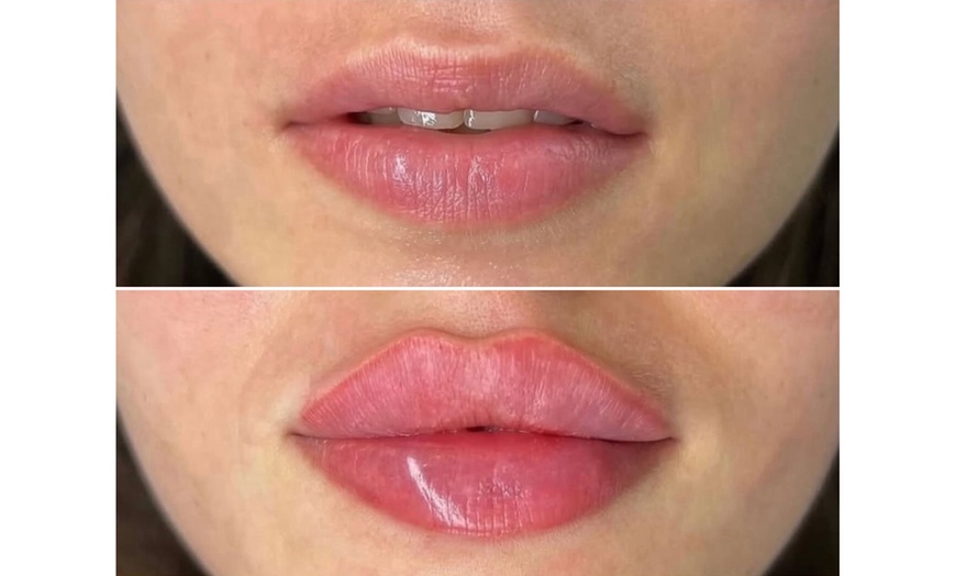 Image 6: Revanesse Versa Dermal Filler: Natural Lip & Facial Enhancement