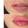 Image 6: Revanesse Versa Dermal Filler: Natural Lip & Facial Enhancement
