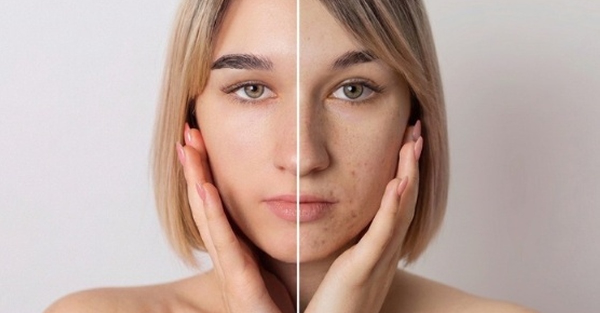 Tratamiento facial para el acné en Bilbao