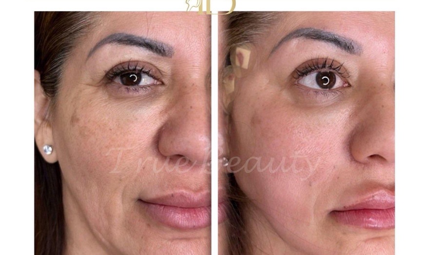 Image 2: Discover the Magic of Youth with Custom PDO Smooth or Barb Thread Lift