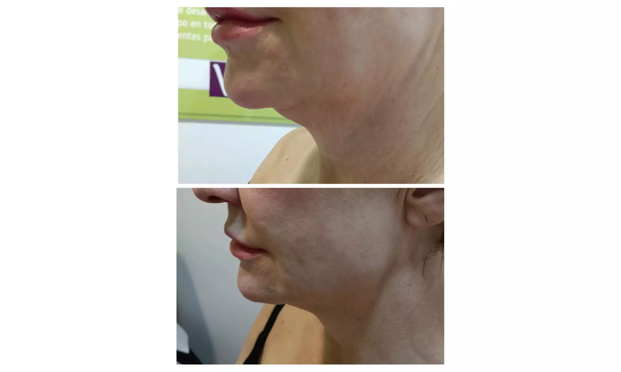 Tratamiento HIFU V10 MAX INDOLORO en rostro para 1 persona