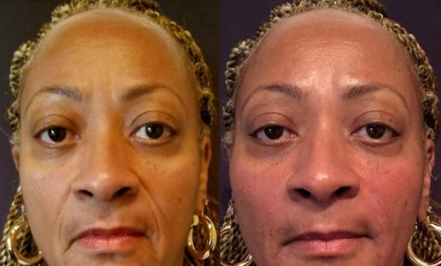 Image 5: Refresh Your Look with 20 or 40 Units of Botox
