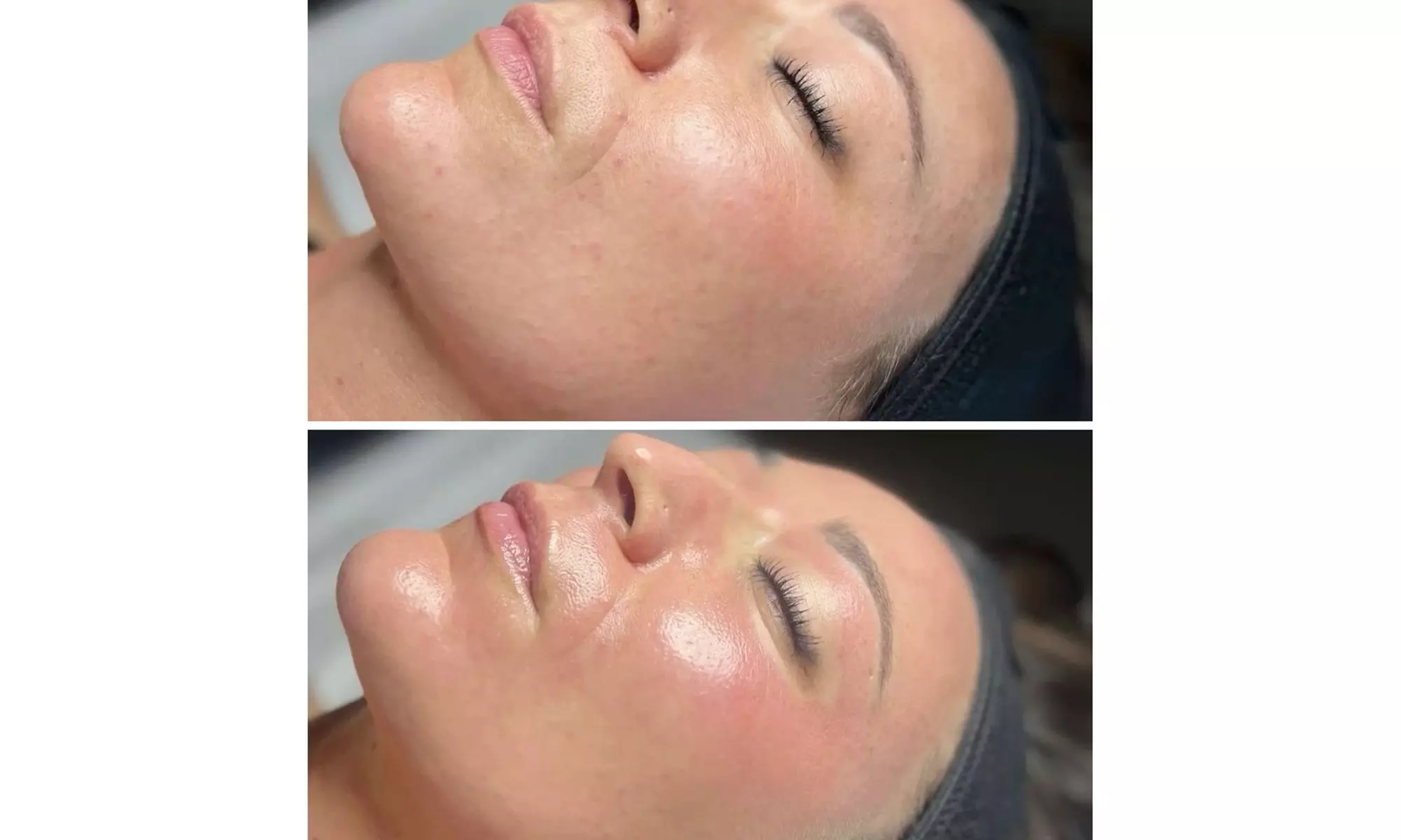 Experience One or Three Sessions of Korean Glow Micro-Needling for Youthful Radiance (Up to 33% Off) - Image 3