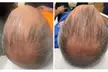 Up to 60% Off on Hair Restoration - Non-Surgical at Mar Essence - Second Medium
