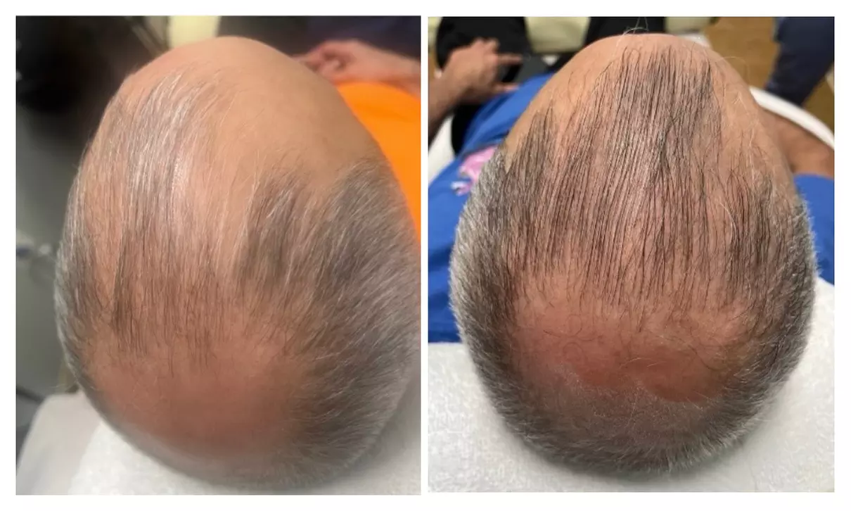 Transform Your Hair with One Single Session of TED Hair Restoration