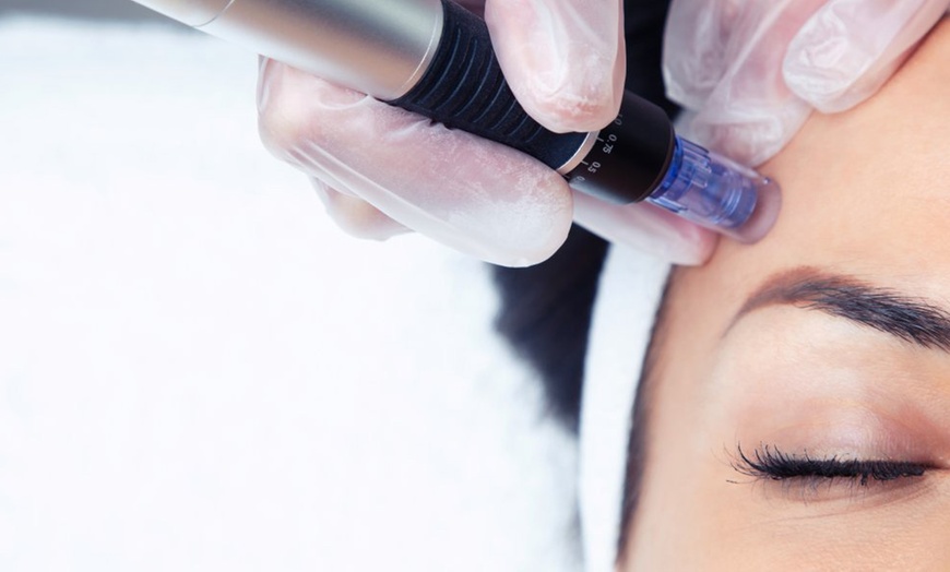 Image 2: Sesiones de rehidratación de labios o microlifting facial con Dermapen