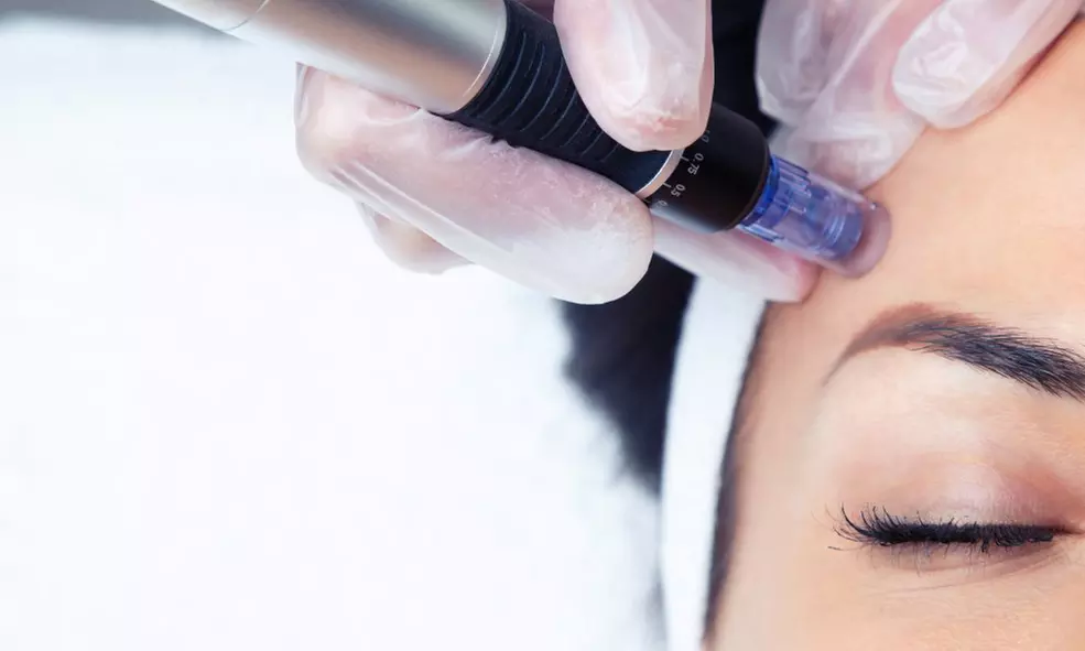 Sesiones de rehidratación de labios o microlifting facial con Dermapen