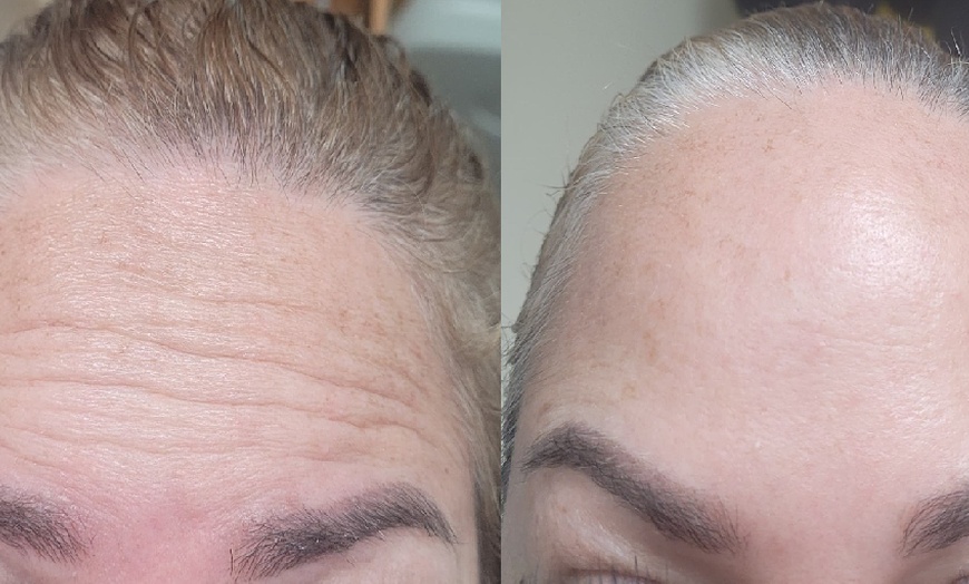 Image 3: Get Refreshed with 20, or 40 Units of Xeomin Injections 