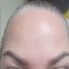 Image 3: Get Refreshed with 20, or 40 Units of Xeomin Injections 