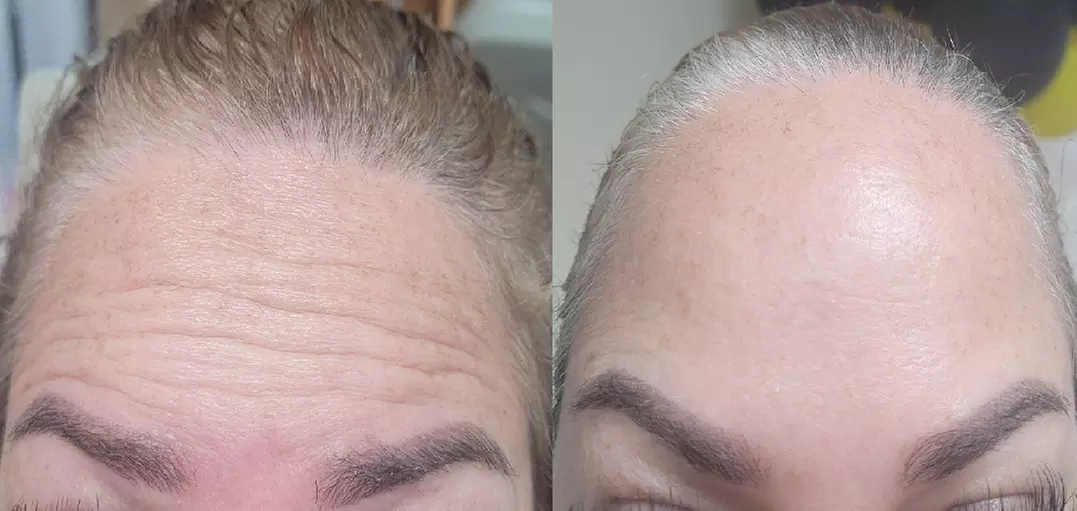Get Refreshed with 20, or 40 Units of Xeomin Injections