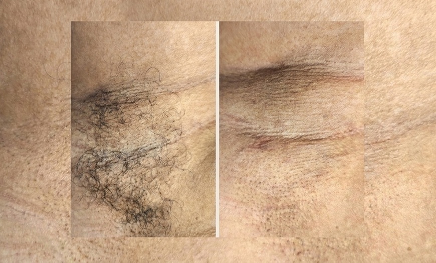 Image 7: Achieve Smooth Skin w/ an Underarm or Bikini/Brazilian Wax /the Combo
