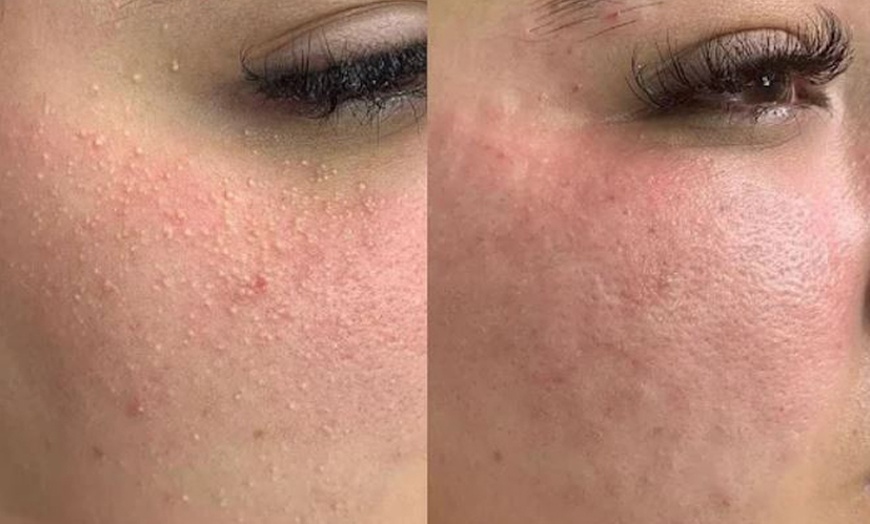 Image 5: 60-Minute 1, 2, or 3x Choice-of Facials (Acne or Microdermabrasion)