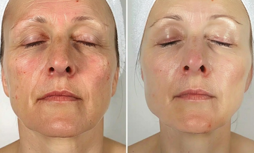 Image 5: Rejuvenate with Polynucleotides: One, Three, or Six Sessions!