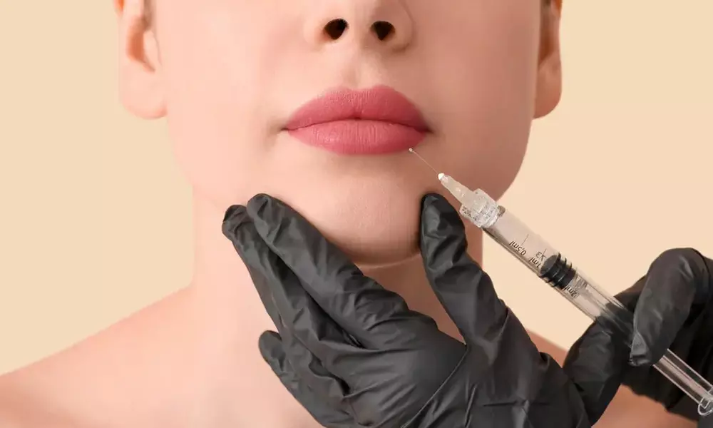 One Syringe of Restylane Kysse or Restylane Lyft or Both and More