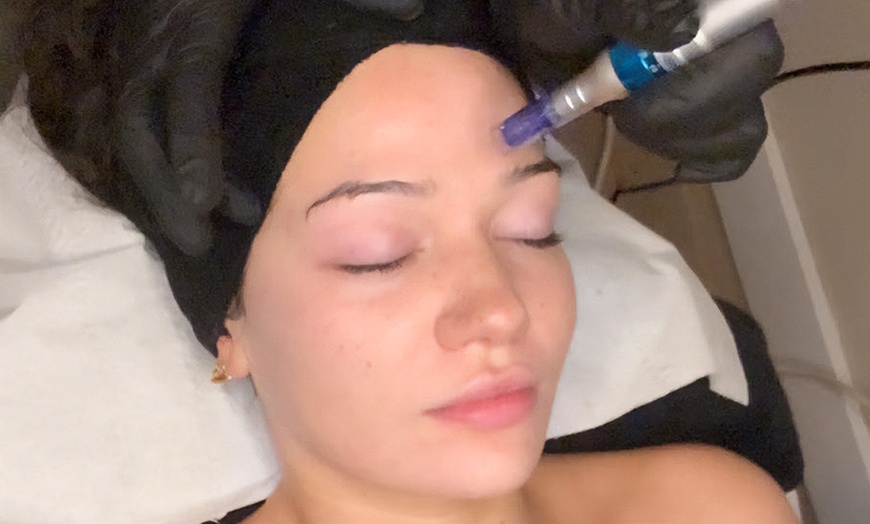 Image 1: Refresh Your Skin with One  or Two Sessions of Microneedling 