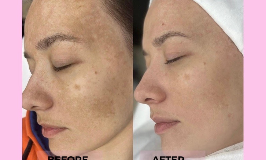 Image 1: Brighten & Refresh with Luxury Chemical Peels! Factorfive, Vi Peel, BioRePeel & Microneedling for Glowing Skin

