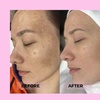 Image 1: Brighten & Refresh with Luxury Chemical Peels! Factorfive, Vi Peel, BioRePeel & Microneedling for Glowing Skin

