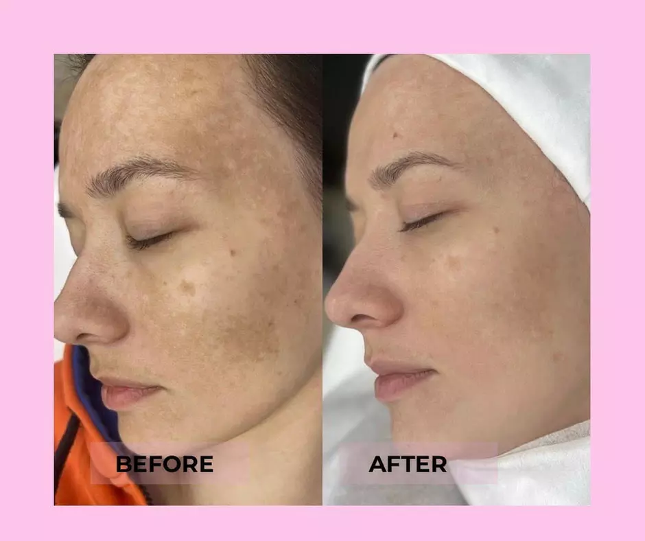 Brighten & Refresh with Luxury Chemical Peels! Factorfive, Vi Peel, BioRePeel & Microneedling for Glowing Skin

 - Primary Image