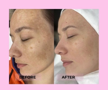 One Chemical Peel BioRepeel (Downtime Chemical Peel Safe for any Skin Type all Year around) - Beauty Factory Spa