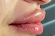 Smooth, Plump, & Perfect: Versa Enhancements at Divaa Beauty (Up to 40% Off) - Second Medium