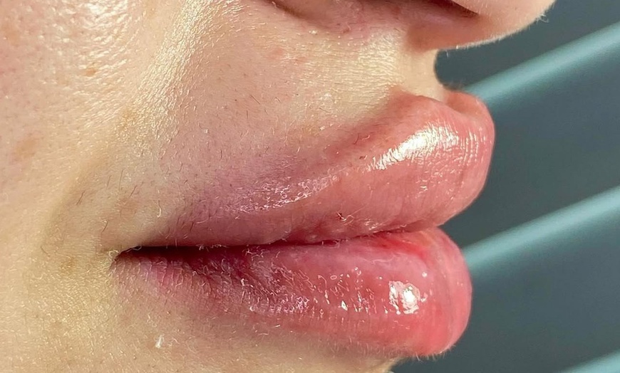 Image 6: Smooth, Plump & Perfect: Versa Enhancements at Divaa Beauty