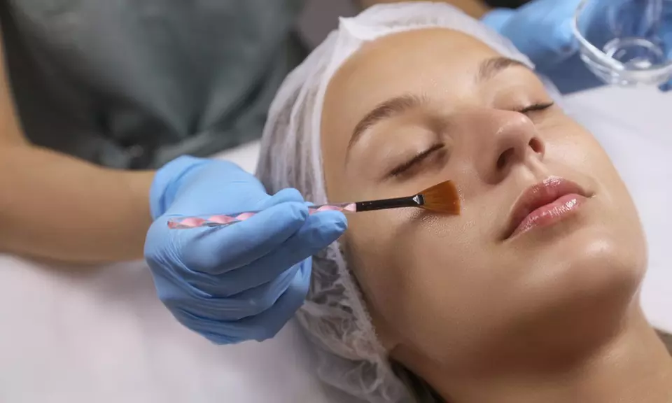 Get 1x, 3x, or 5x Chemical Peel Session for Face, Neck & Decolletage