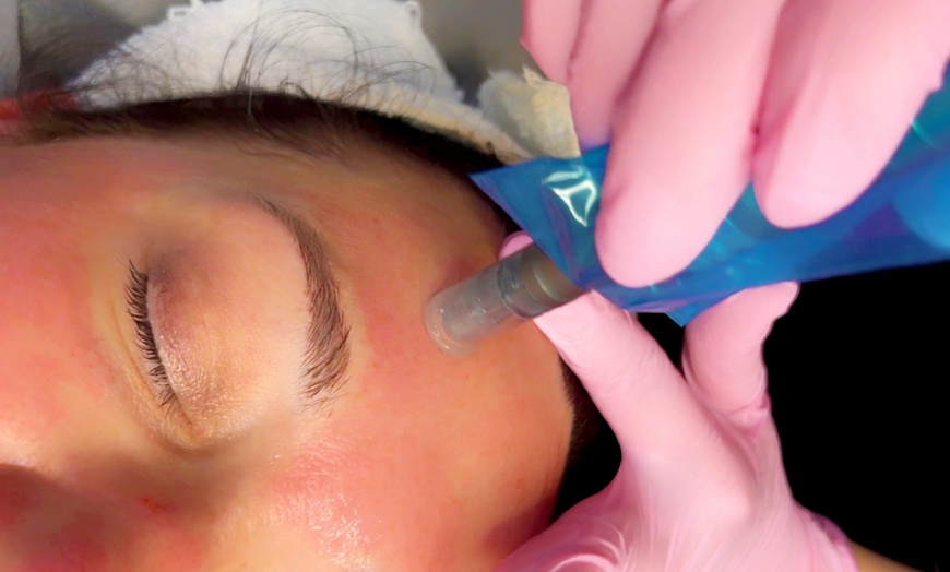 Image 6: 1 o 3 sesiones de dermapen facial con vitaminas o exosomas