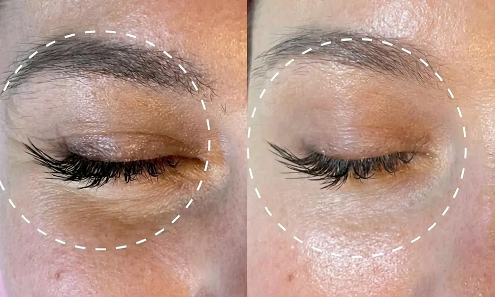 Niechirurgiczny lifting RF