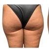 Image 5: Body-Tite – Non-Invasive Cellulite Reduction & Skin Tightening in DC
