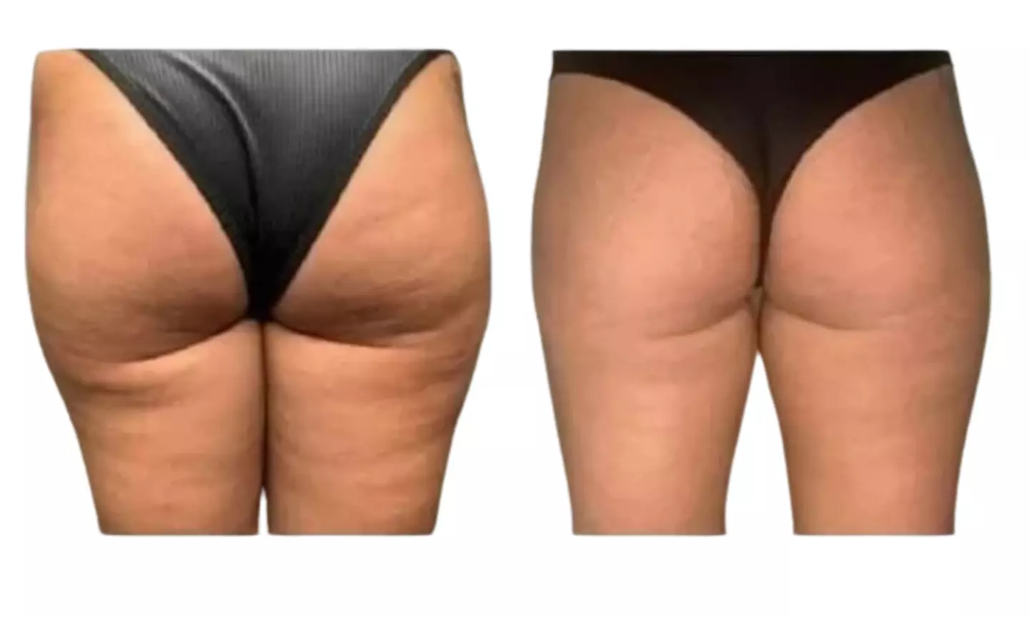 Up to 57% Off on Body-Tite – Non-Invasive Cellulite Reduction & Skin Tightening with Lymphatic Drainage in DC - Second Medium