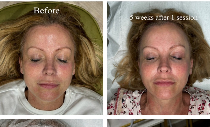 Image 3: Revitalize Skin w/ HIFU Face with Optional Body Area or Neck Treatment