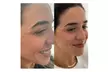 Glow Naturally: 1 or 3 Visits of 2 ML of Salmon DNA Injections (Full Face) At Refine Health (Up to 39% Off) - Second Medium
