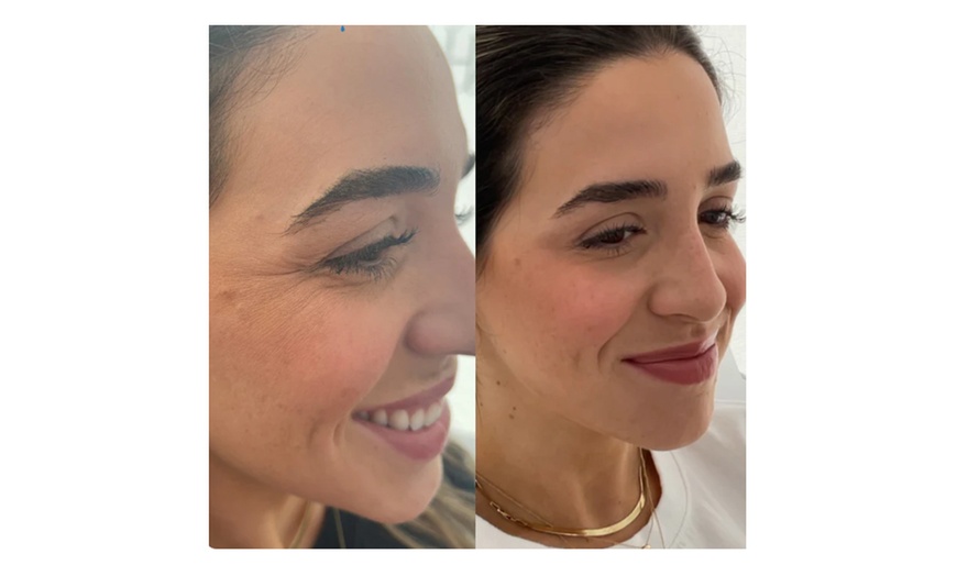 Image 2: Glow with 1 or 3 Visits of 2 ML of Salmon DNA Injections (Full Face)