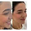 Image 2: Glow with 1 or 3 Visits of 2 ML of Salmon DNA Injections (Full Face)