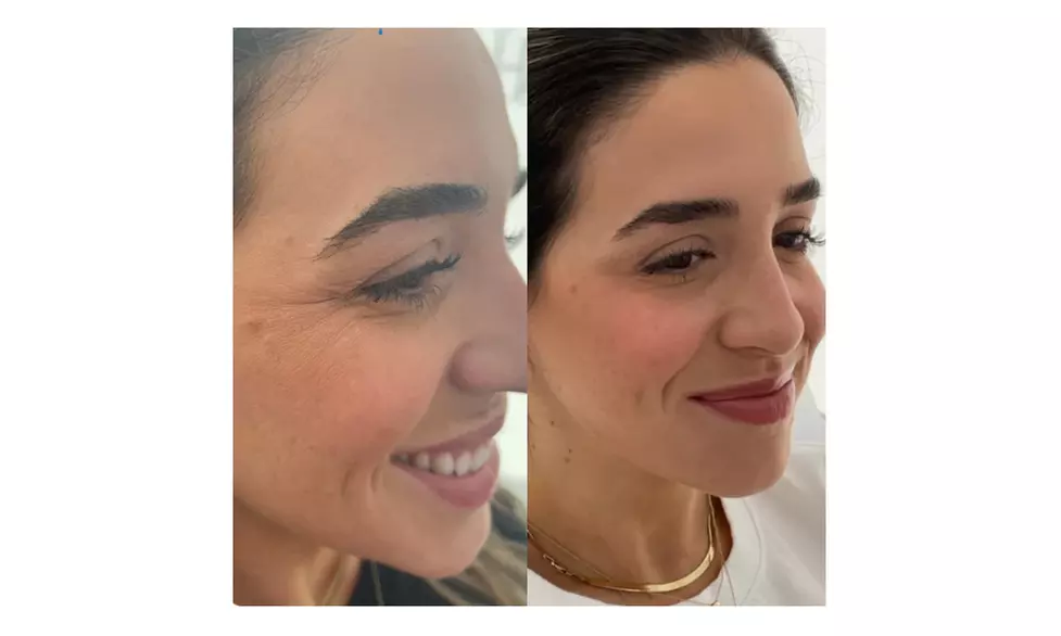 Glow with 1 or 3 Visits of 2 ML of Salmon DNA Injections (Full Face)