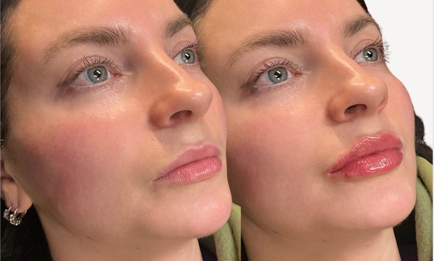 Image 3: Up to 40% Off Dermal Filler at Hush Aesthetics, LLC
