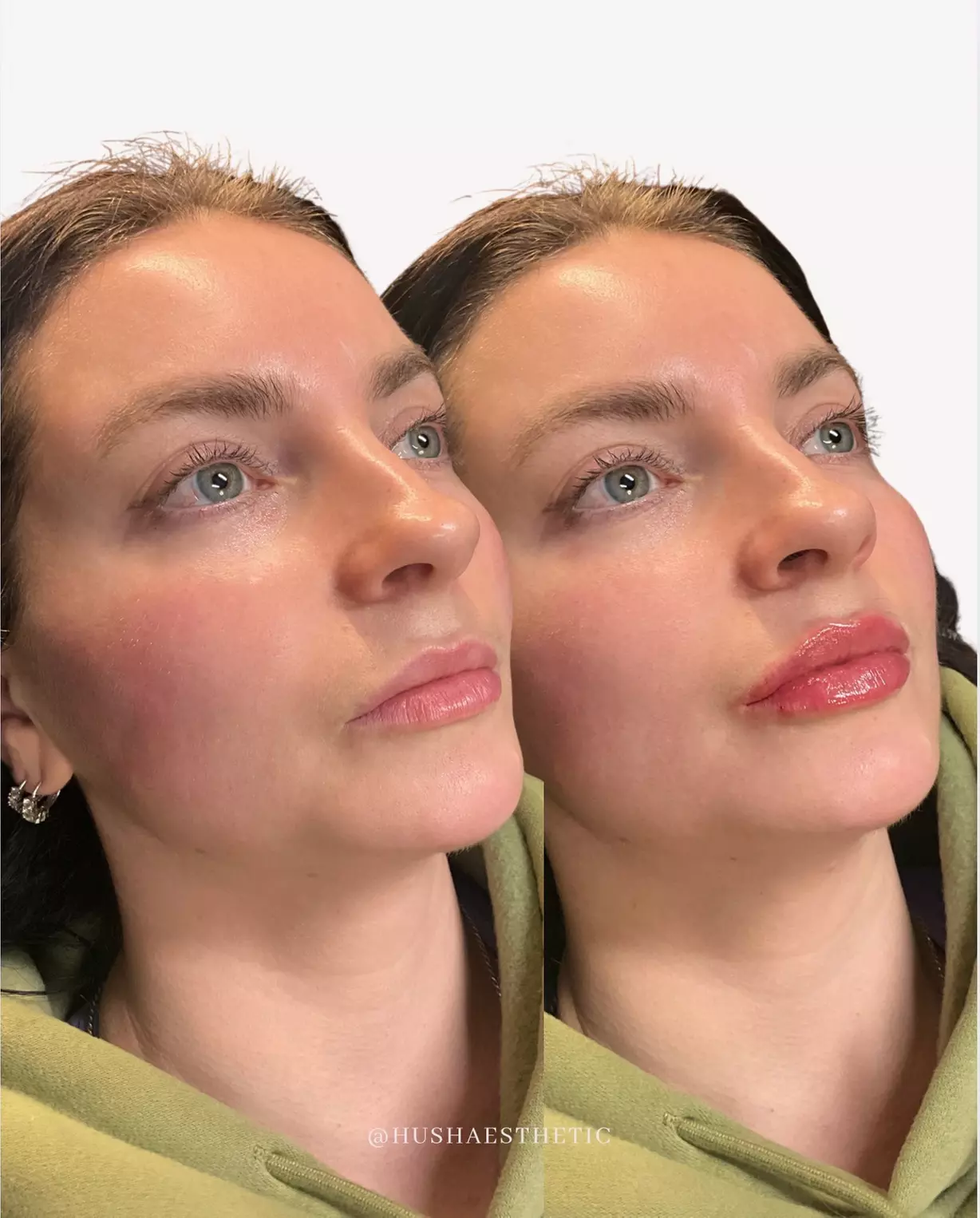 Up to 43% Off Dermal Filler at Hush Aesthetics, LLC