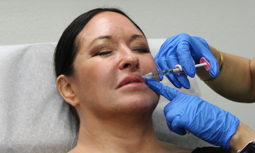 Image 4: 39% Off Smooth Lines with Juvederm Ultra XC
