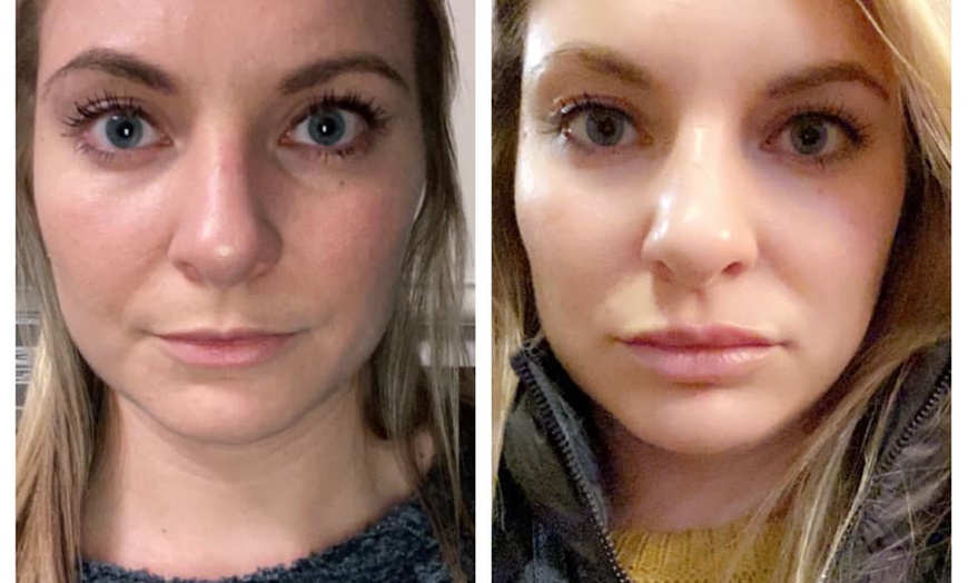 Image 3: Revanesse Versa Dermal Filler for Lips or Under Eyes