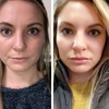 Image 3: Revanesse Versa Dermal Filler for Lips or Under Eyes