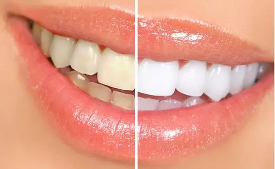 Examen, diagnostico y limpieza bucal o blanqueamiento con limpieza