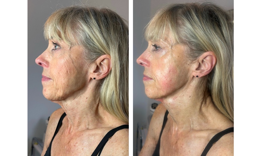 Image 3: Firm & Smooth: 1 or 5 Radio-Frequency Skin-Tightening Treatments