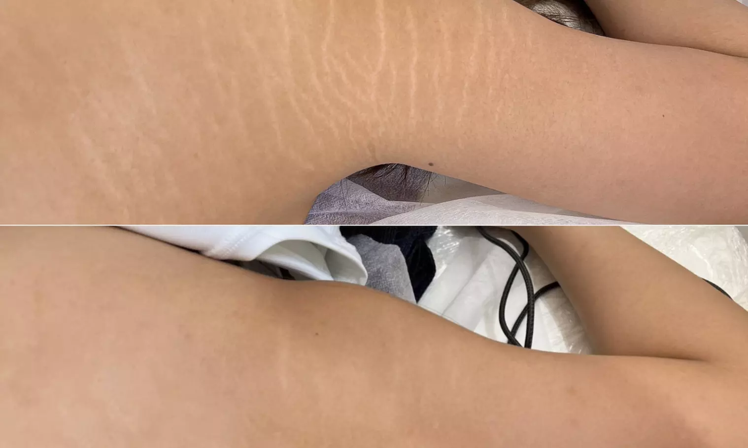 Transform with Stretch Mark Camouflage or Scar Revision/Camouflage